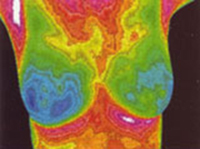 Breast Thermography