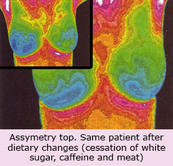 Breast Thermography