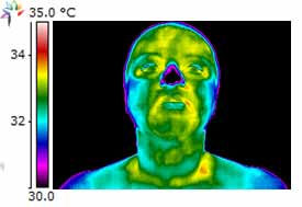 Facial thermographic image consistent with decreased thyroid function