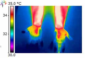 Thermography image consistent with the appearance of carpal tunnel syndrome