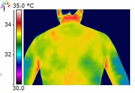 Upper body thermography - posterior neck, upper back and posterior shoulder warming suggest muscular irritation to the neck, trapezius, infrasoinatus, and suprasoinatus.